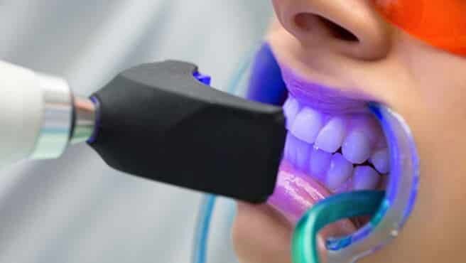 Gouttière dentaire Tunisie : technique blanchiment dentaire