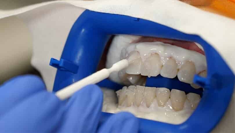 blanchiment dentaire dentiste par gouttiere Lac