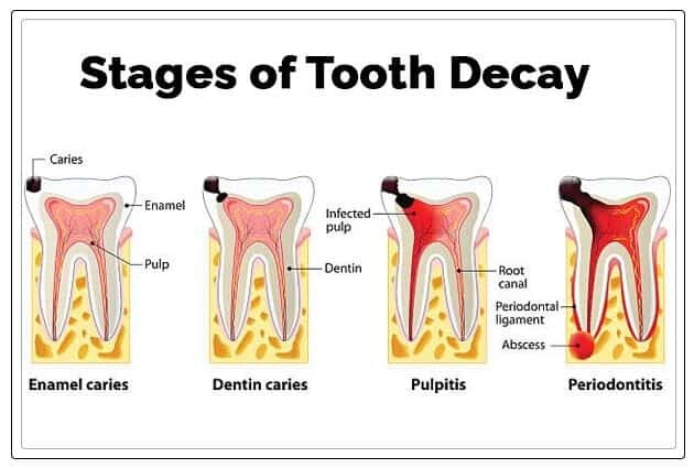 Caries dentaires symptômes et traitement cabinet dentaire lac tunis