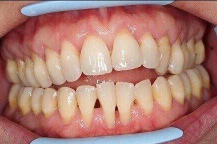 maladie parodontale dents dechaussees