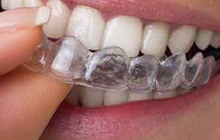 Trouvez vos gouttières dentaires invisibles jusqu'à 60% moins chères