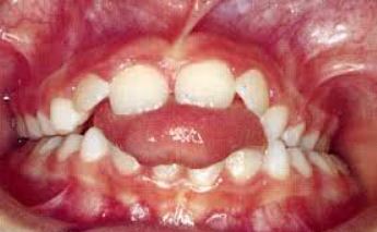 consequence deglutition atypique sur dents