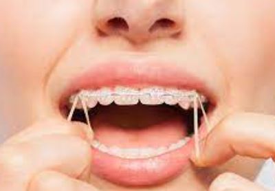 elastique-orthodontique-utilise-cas-malocclusion