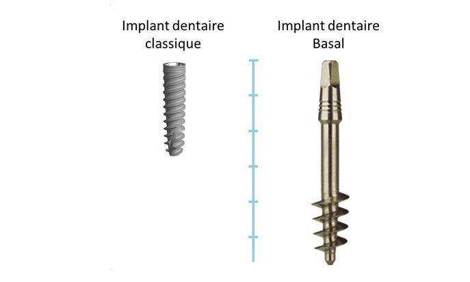 implant dentaire basal