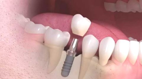 implant dentaire de nouvelle generation