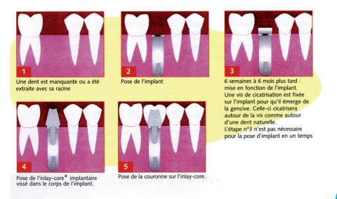 etapes implant dentaire