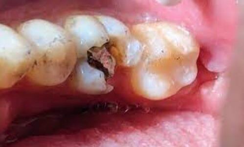 Vous saurez tout sur les plombages dentaires ,leur utilité et leur toxicité