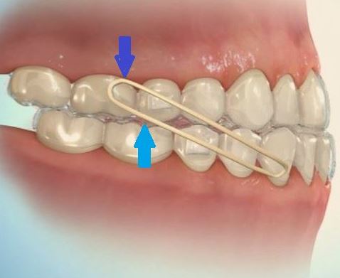 image elastique dans un traitement orthodontique par gouttières